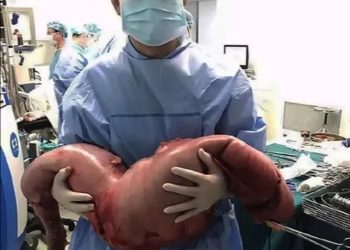 Doctors Remove 13Kg of Faeces from Man Constipated Since Birth